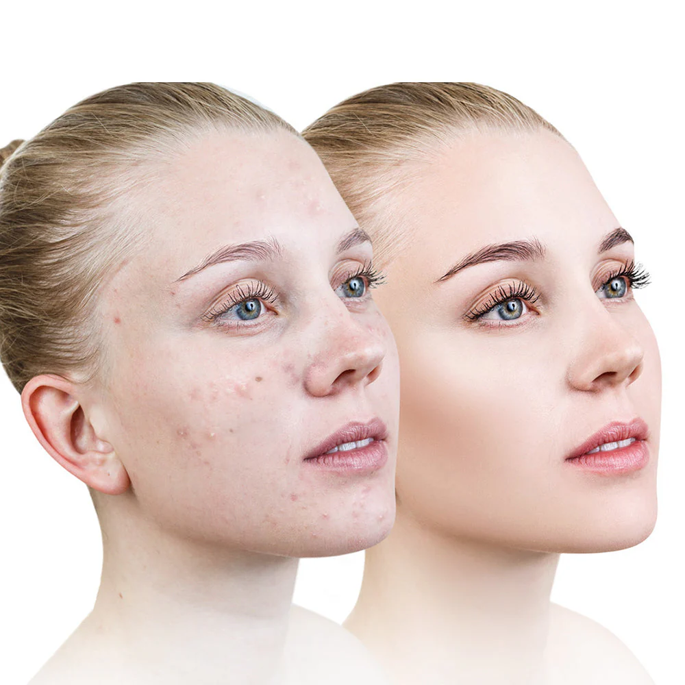 CleanSmooth Cold Plasma Facial Wand - Image 4