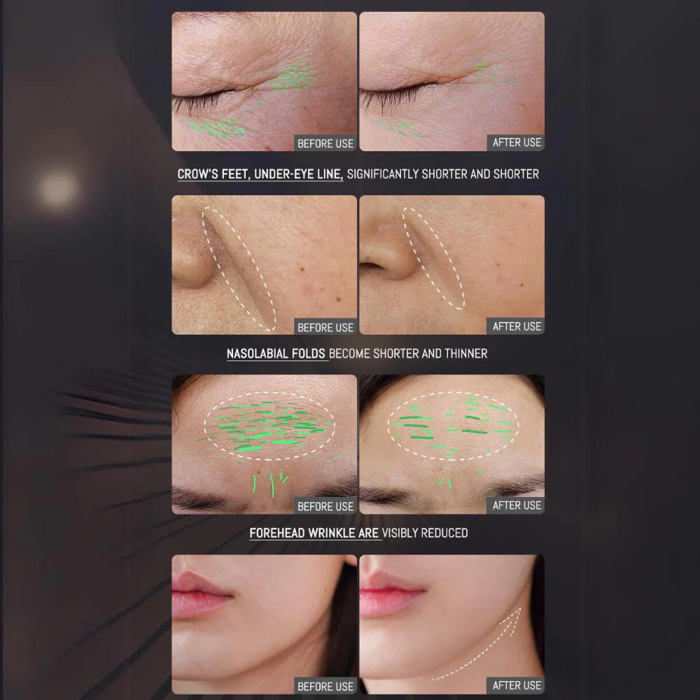 PRO Facial RF Skin Tightening Wand - Image 4
